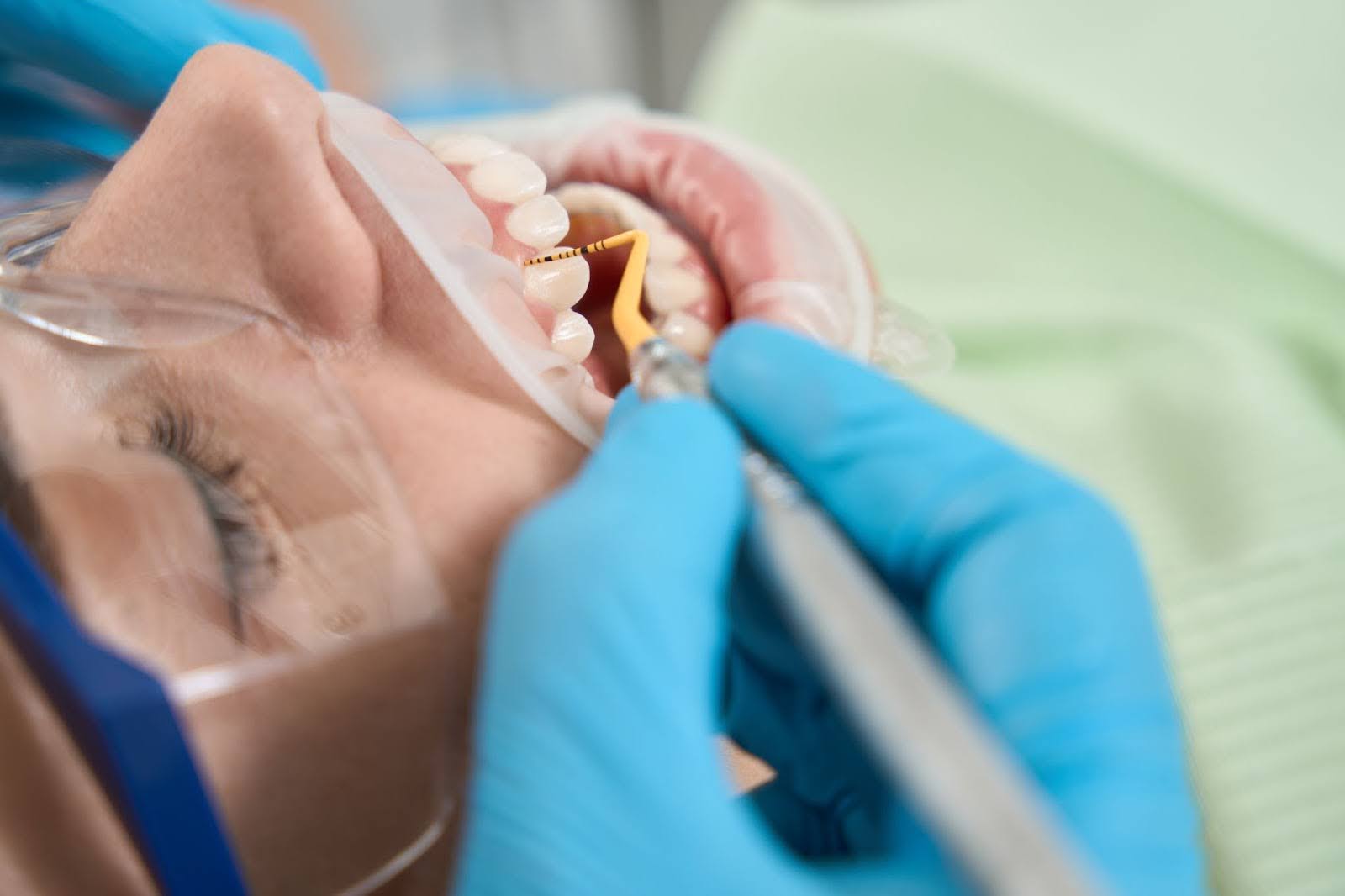 Diagnosing bleeding gums in gum disease involves a comprehensive assessment by dental professionals