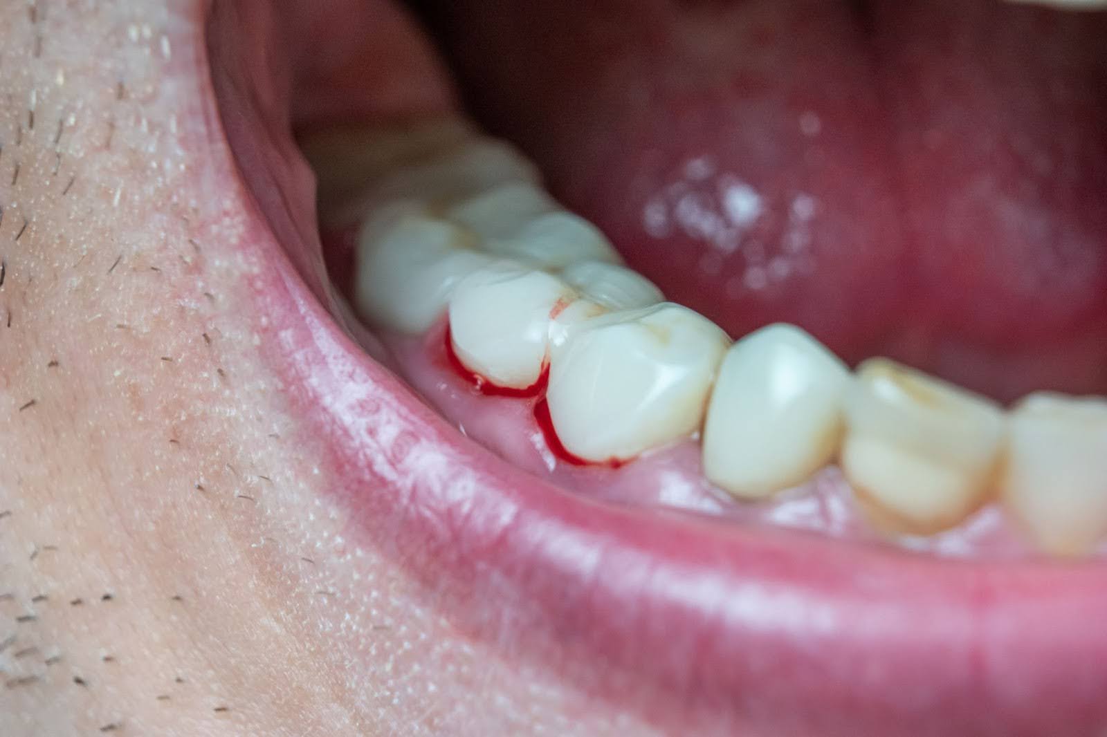 Bleeding gums are a common and often alarming symptom of gum disease