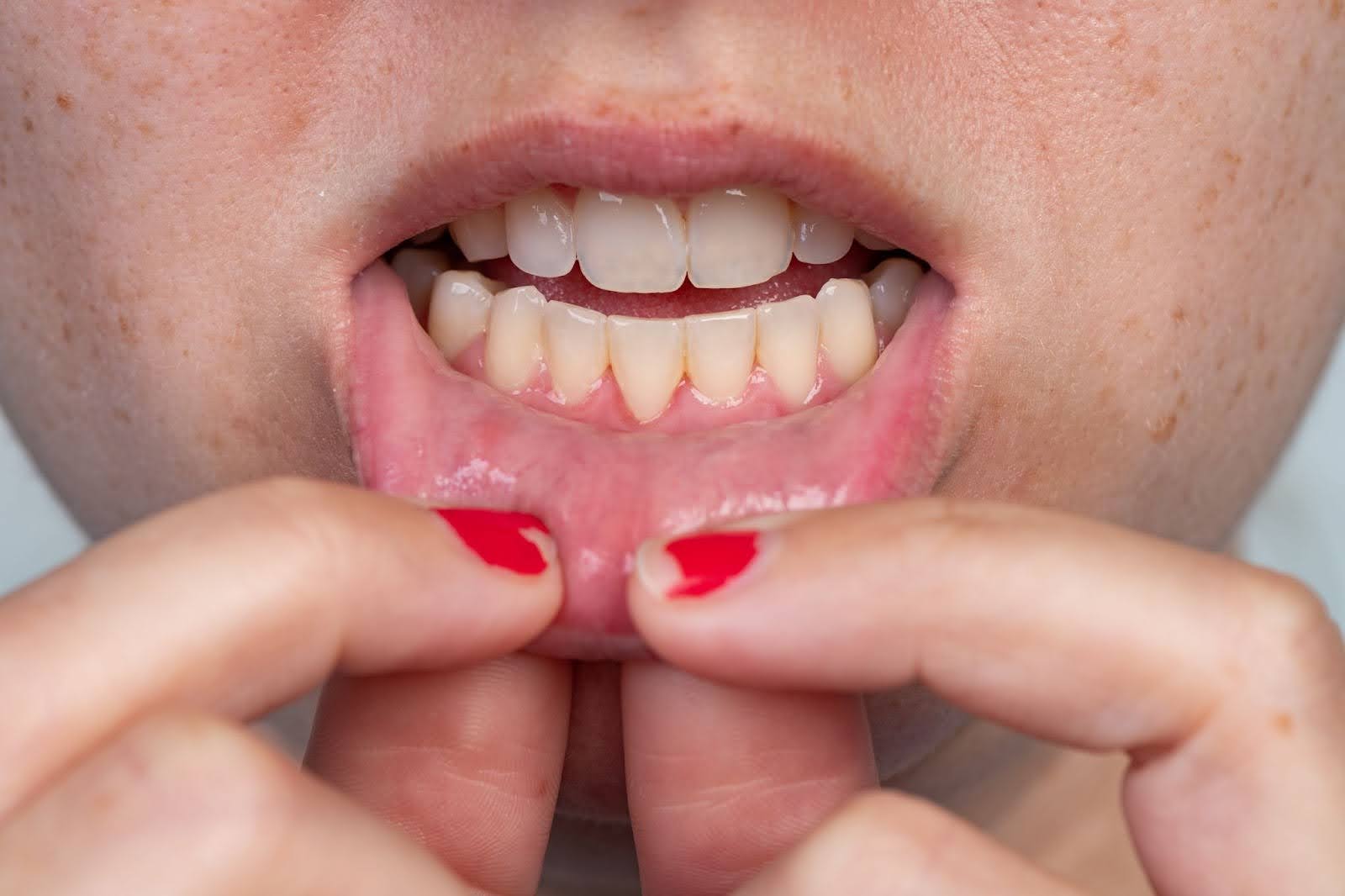 Gum Disease Symptom: Gum Recession