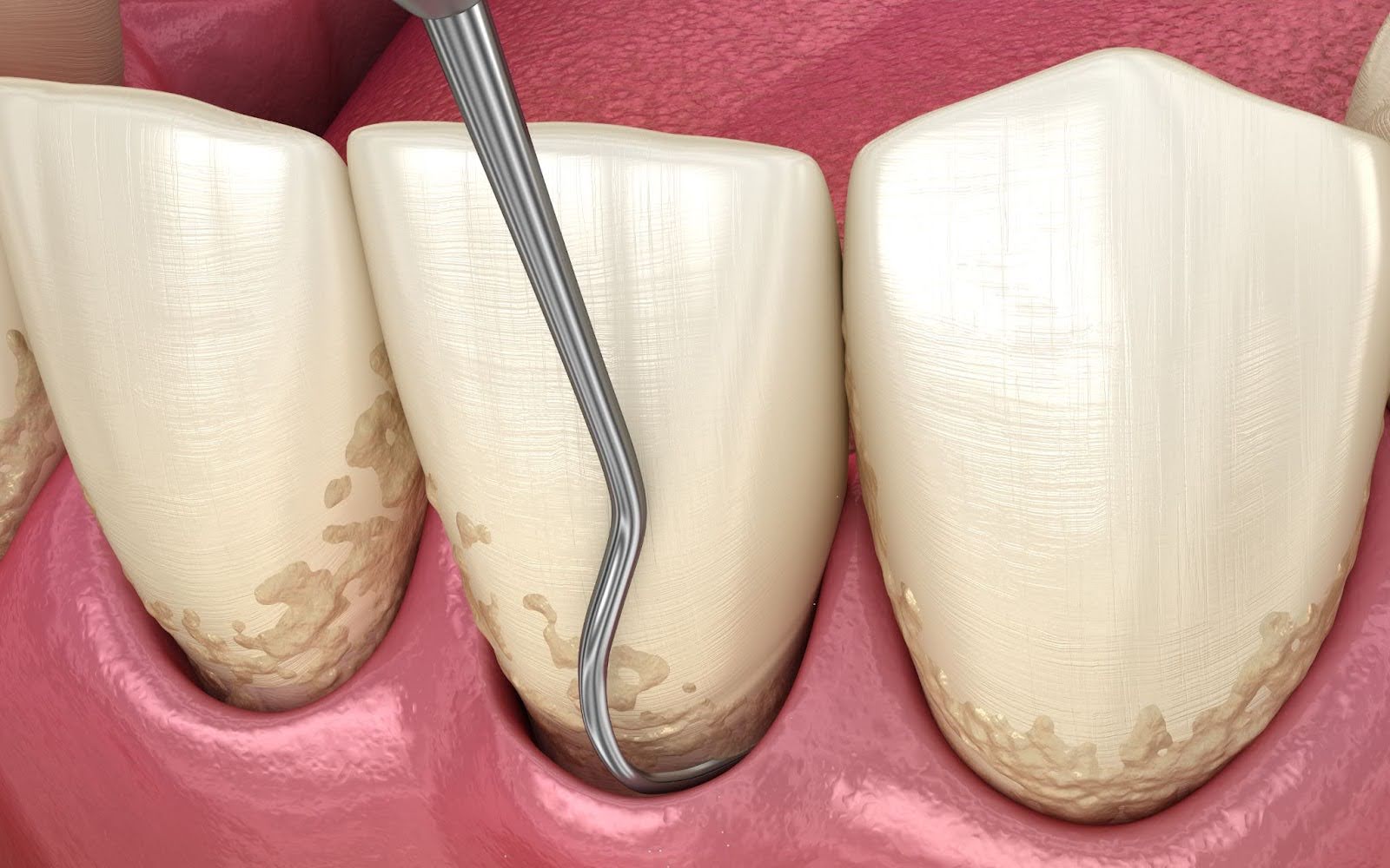 How does scaling and root planing help address gum recession?