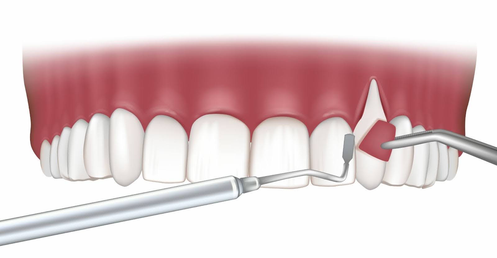 What surgical treatments are available for gum recession?