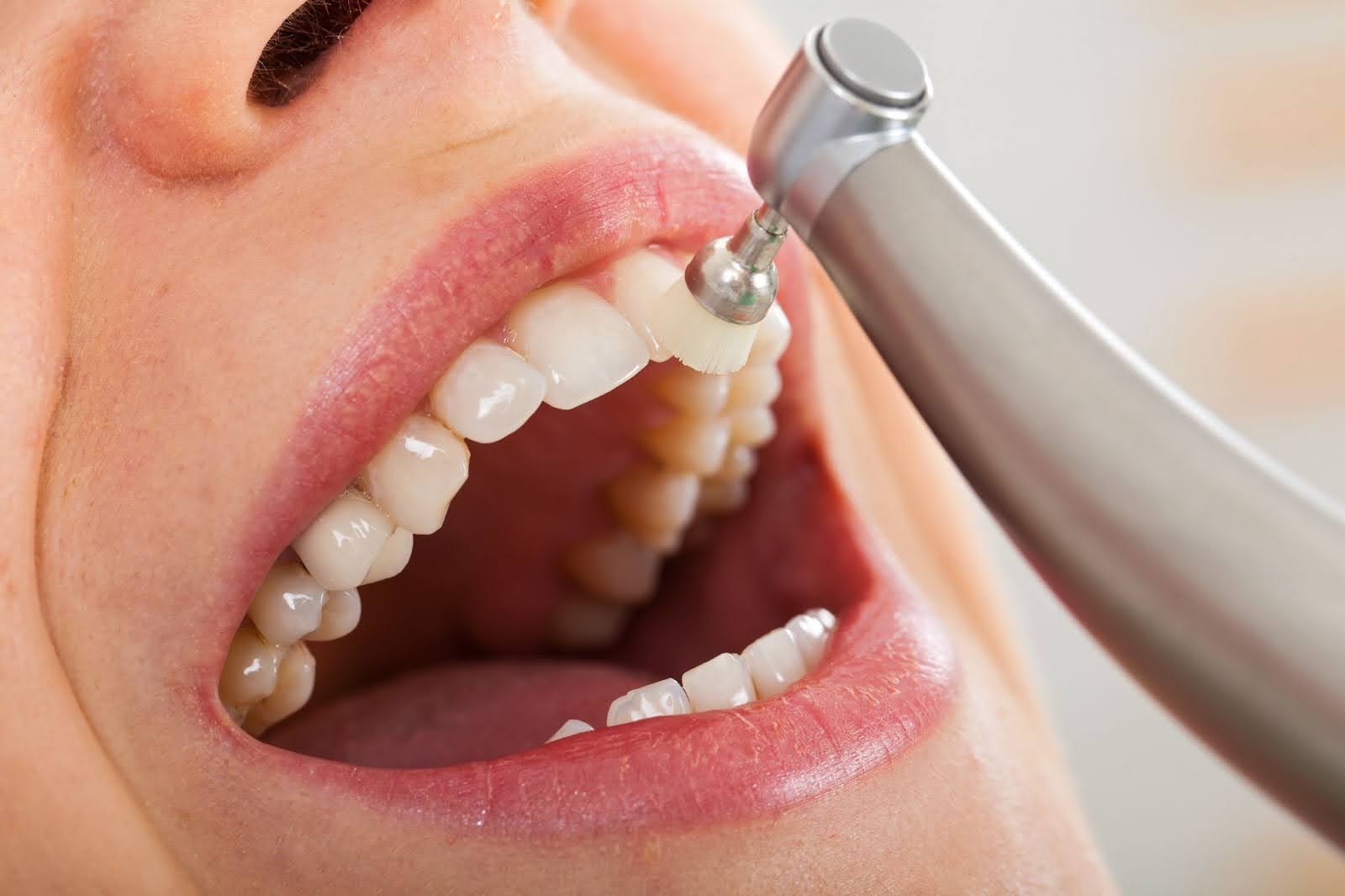 How do professional dental cleanings help in reducing tooth sensitivity? 
